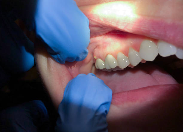 Best Emergency Dentist for Lost Fillings or Crowns in Apache Junction, AZ